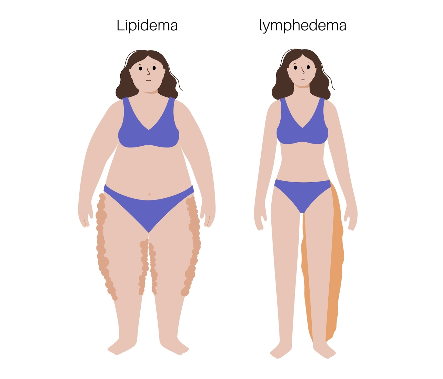 How to Help Lipedema and Lymphedema - Part 1