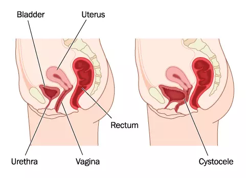 Treating Pelvic Organ Prolapse with Pelvic Floor Therapy