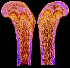 Osteoporosis | Image Credit: "Dlx3 deletion in osteoblast progenitors induce increased trabecular bone formation " by National Institutes of Health (NIH) is licensed under CC BY-NC 2.0