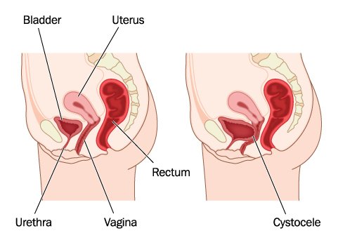 Prolapsed Uterus Treatment - Propel Physiotherapy