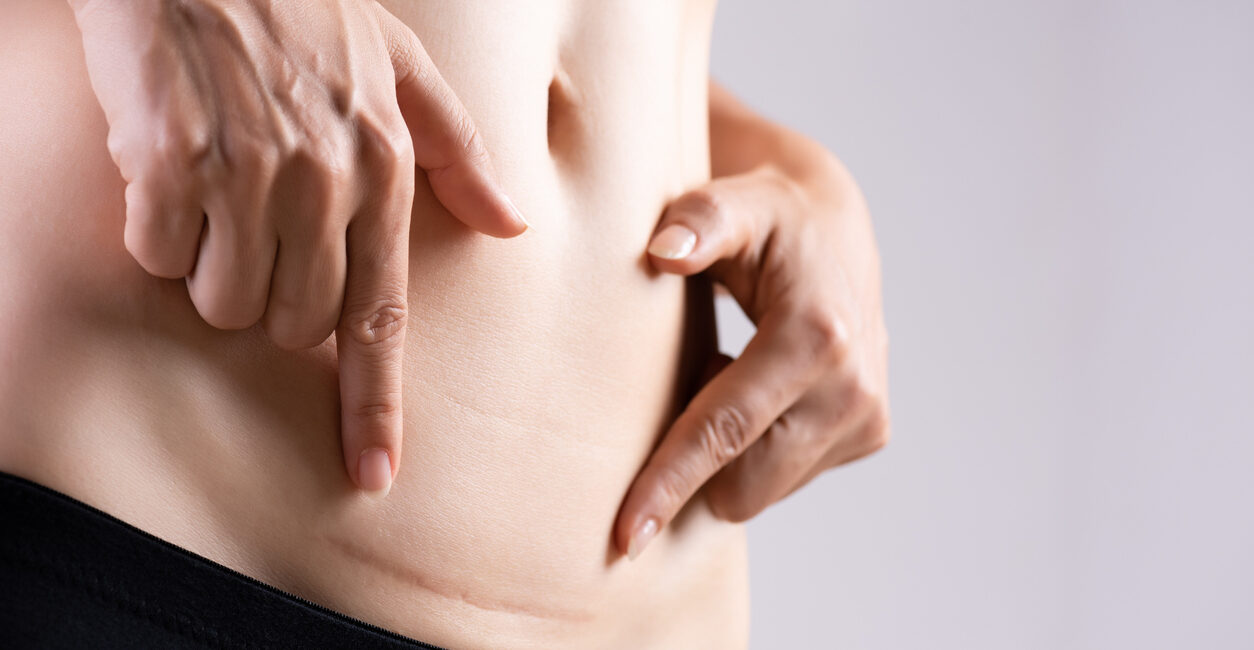 Scar Management and Desensitization After C-Section, Hysterectomy, and Laparoscopic Procedures