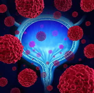 Sex After Cystectomy | What Women Need To Know Before Bladder Surgery