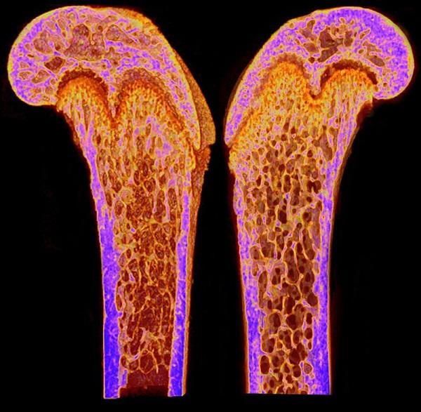 Osteoporosis Awareness Month: Bone Health and Prevention