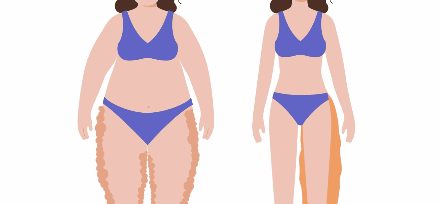 How to Help Lipedema and Lymphedema – Part 1