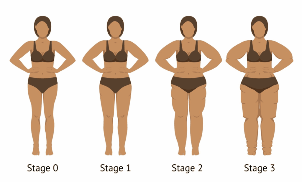 How to Help Lipedema and Lymphedema - Part 2