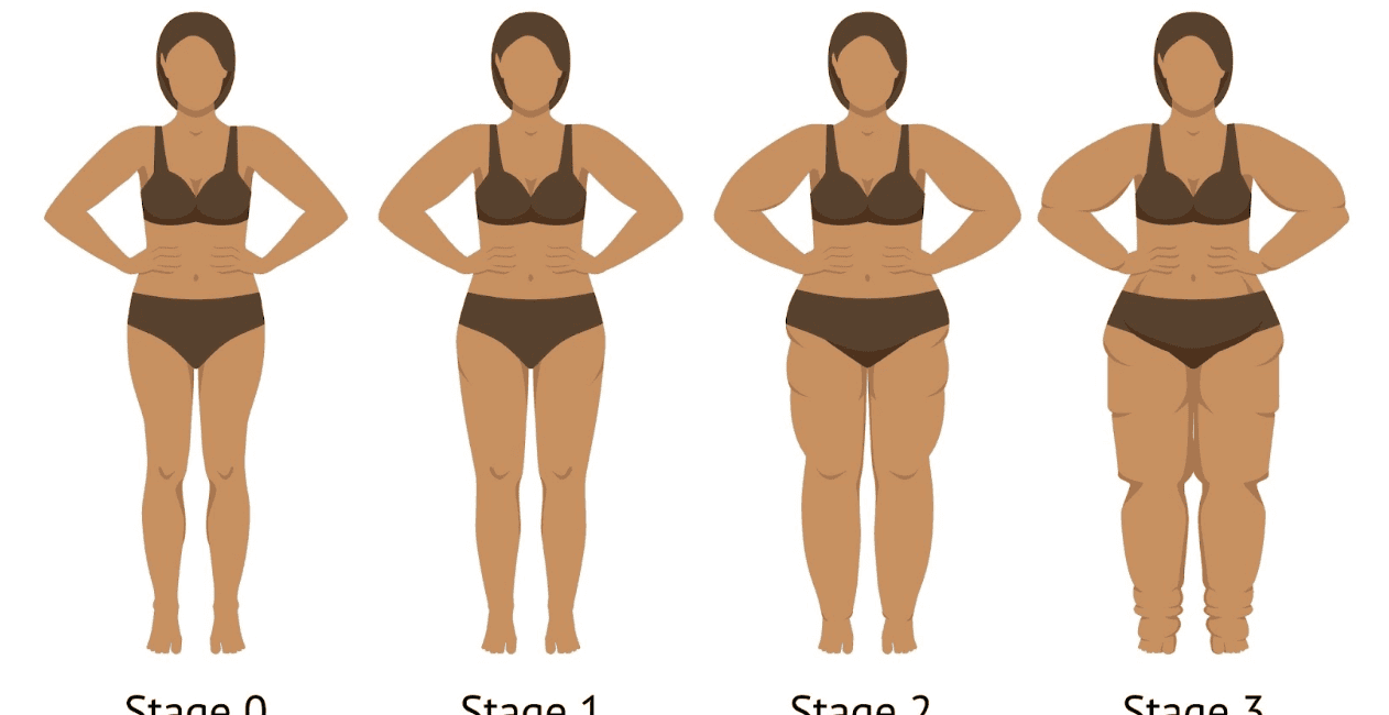 How to Help Lipedema and Lymphedema – Part 2