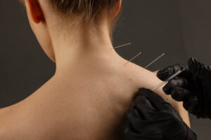 Dry Needle Therapy in Atlanta