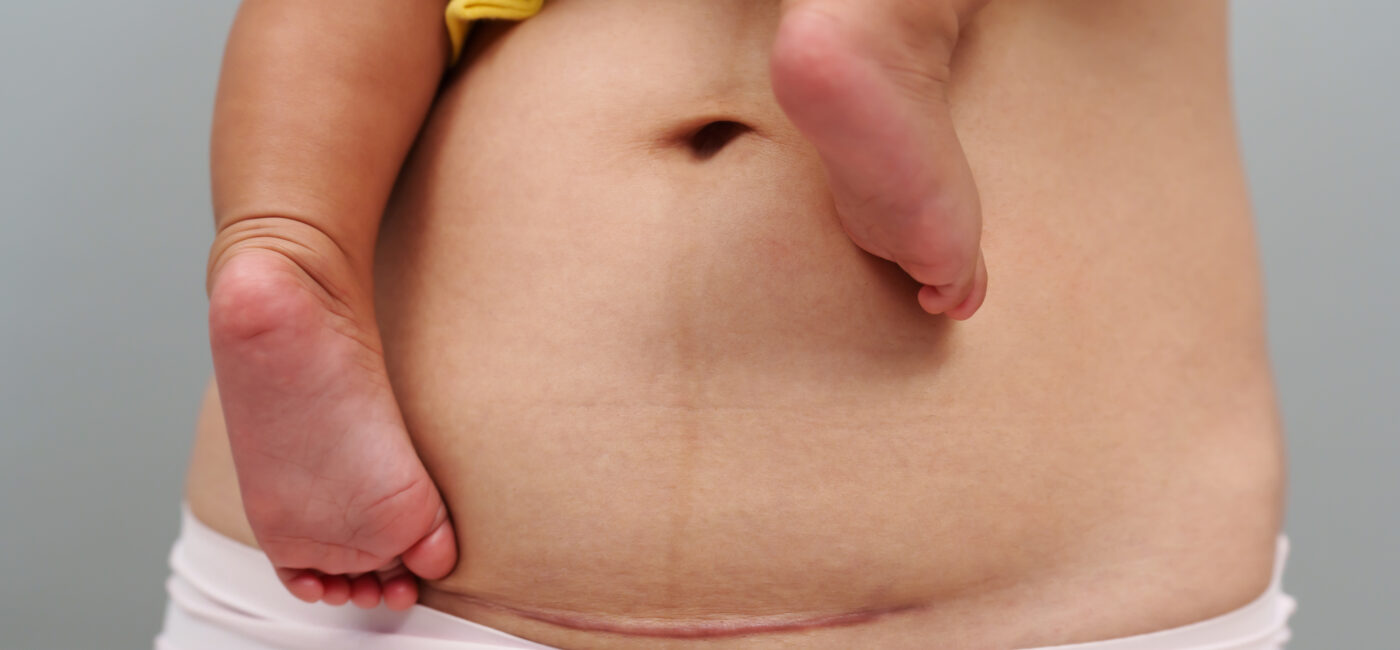 Treatment Options for Postpartum Pelvic Pain Therapy in Los Angeles, CA